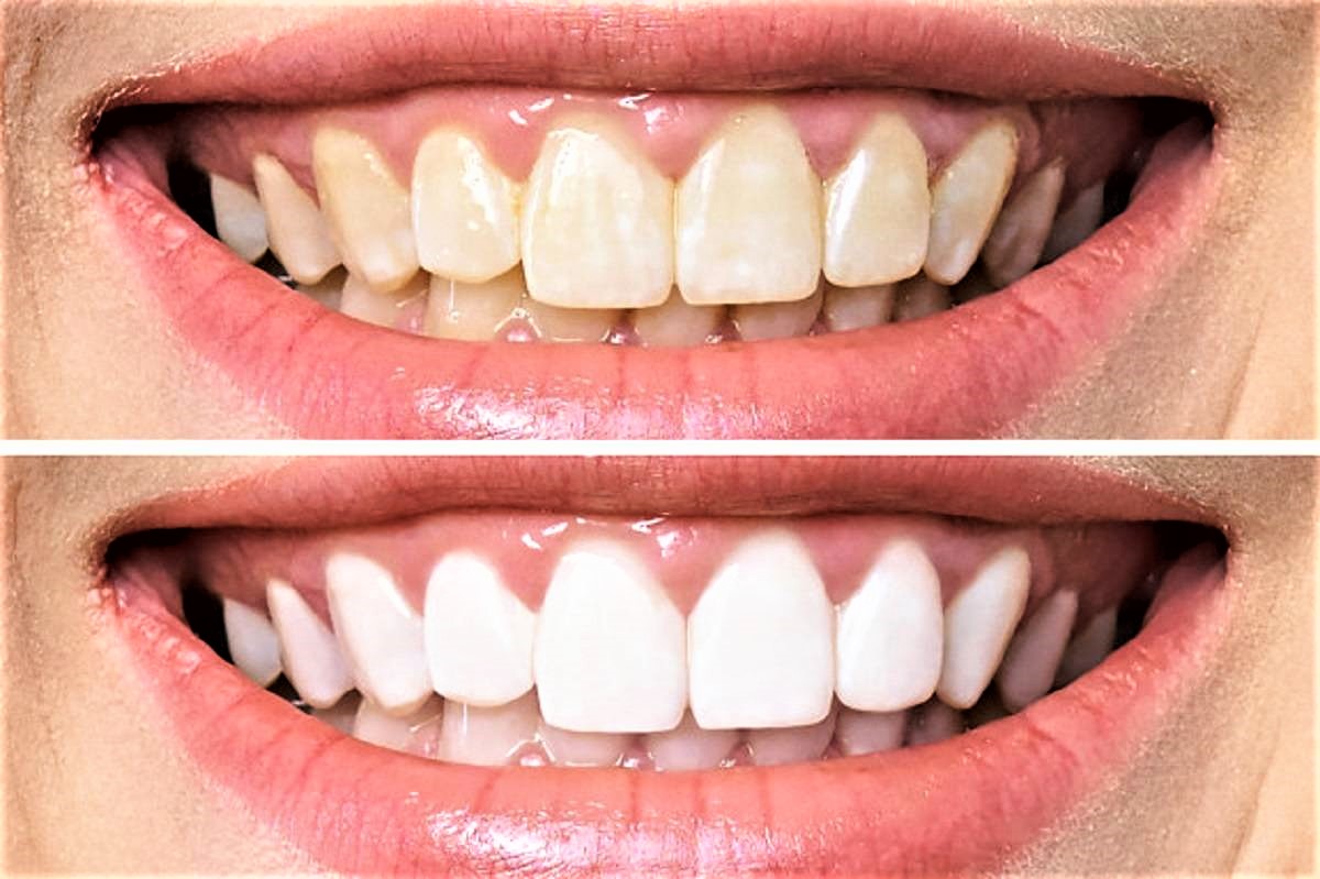 لأسنان بيضاء كاللؤلؤ استخدمي خلطة القرنفل لتبييض الاسنان وازالة الجير والاصفرار نهائياً